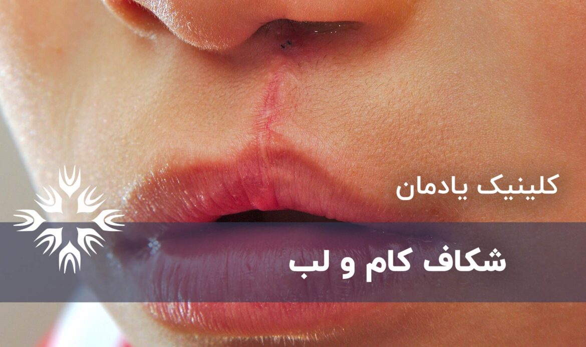 شکاف کام و لب