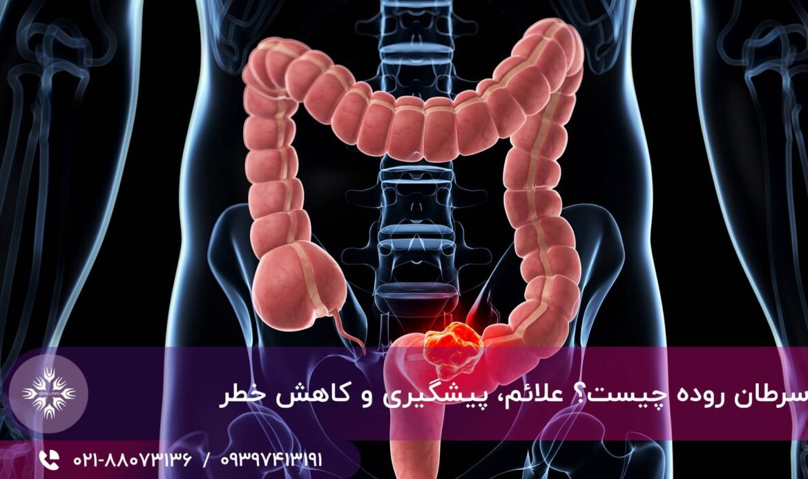 سرطان روده
