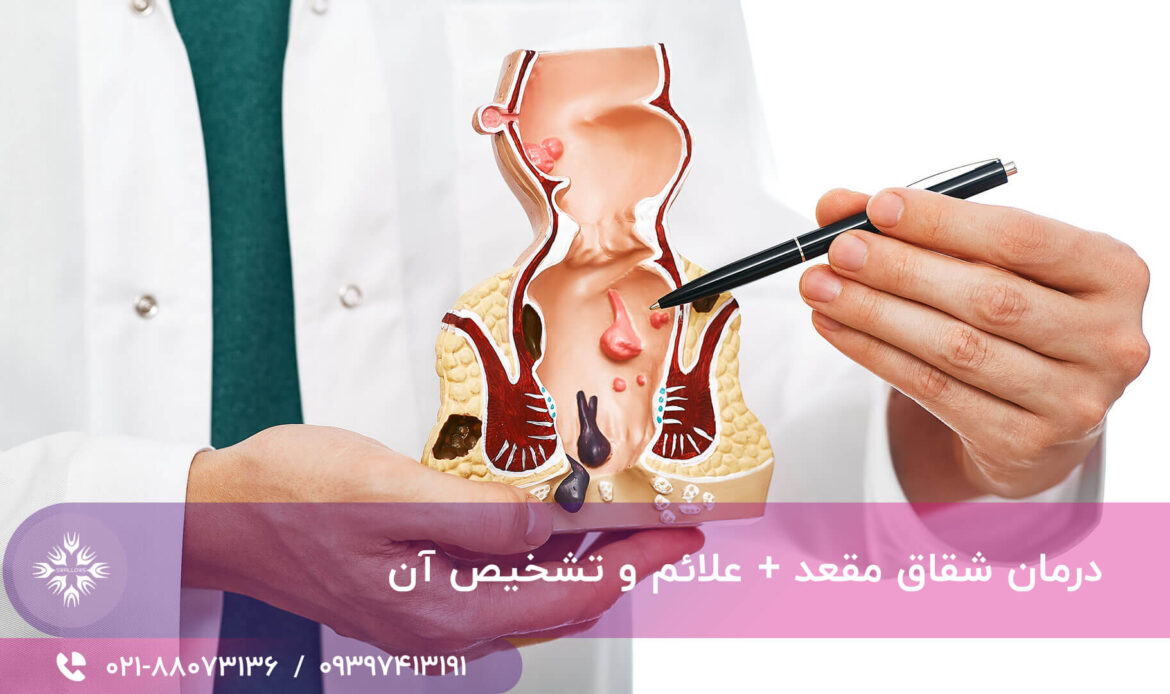 شقاق مقعد