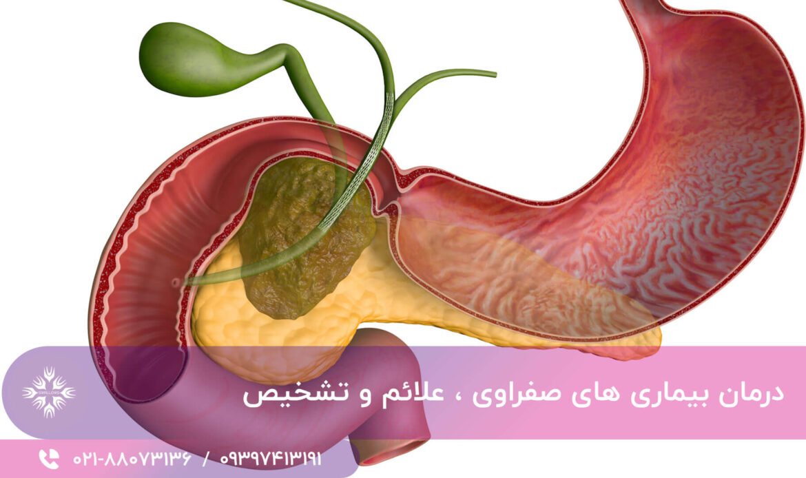 بیماری های صفراوی