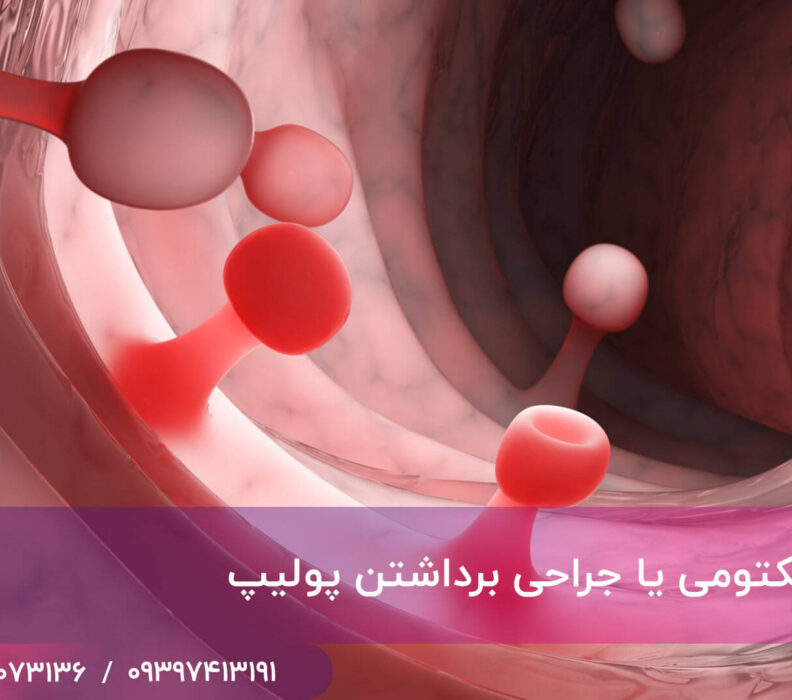 پولیپکتومی یا جراحی برداشتن پولیپ
