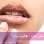علت خشکی دهان + علائم و درمان