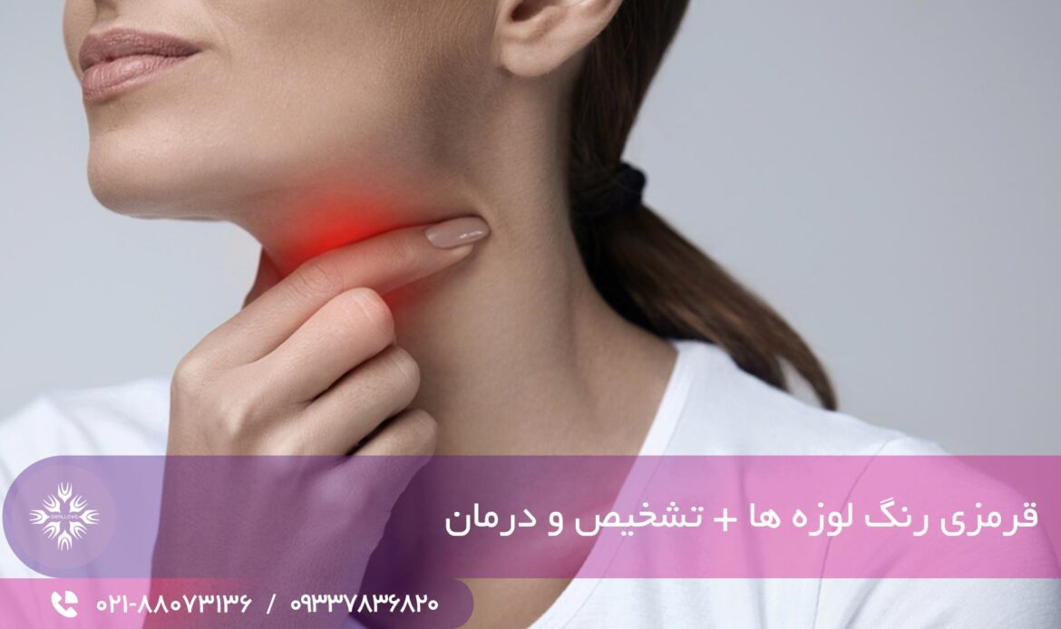 قرمزی لوزه