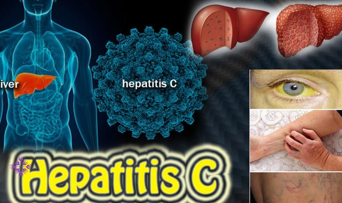 علائم التهاب کبدی یا هپاتیت c