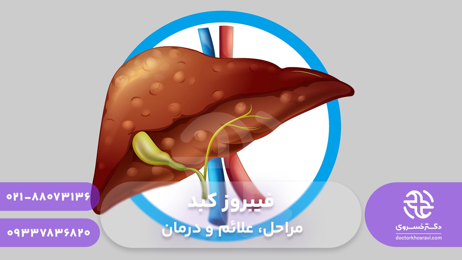 فیبروز کبد : مراحل، علائم و درمان